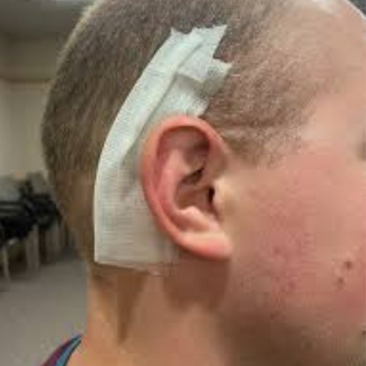 ENT Dressing - Advanced Wound Care Dressing