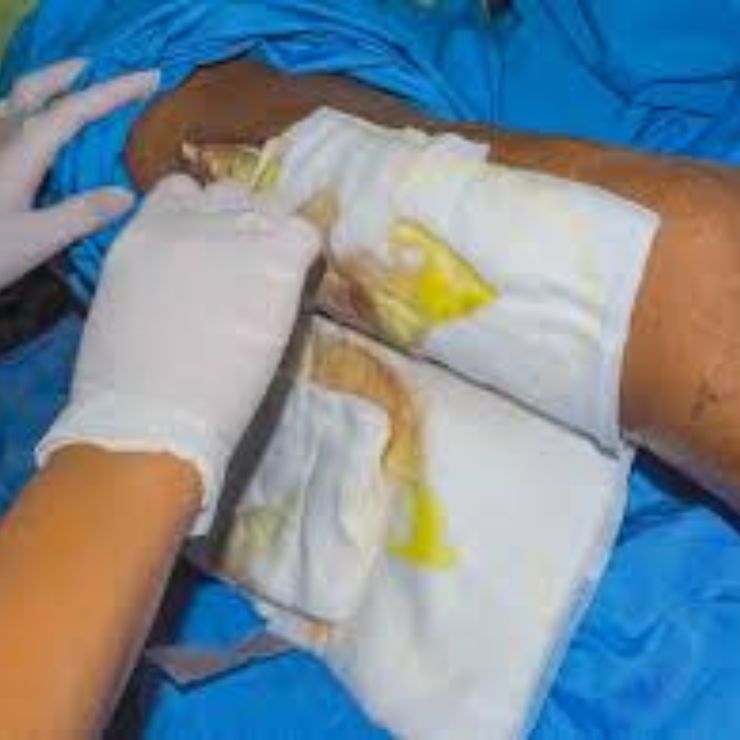 All Types of Post-Operative Dressings - Advanced Wound Care Dressing
