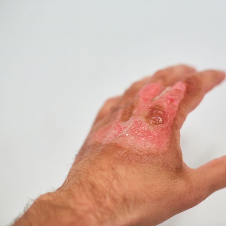 Burn Dressing - Advanced Wound Care Dressing