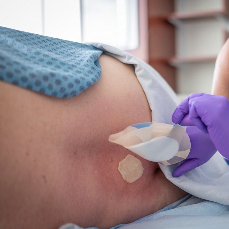 Bedsore Dressing - Advanced Wound Care Dressing