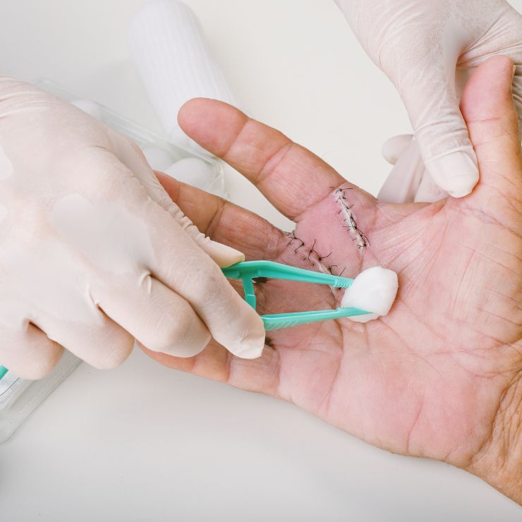 Hand and Finger Injury Dressing - Advanced Wound Care Dressing